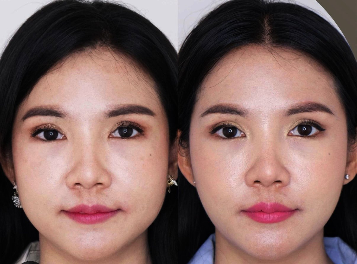 FACIAL SLIMMING